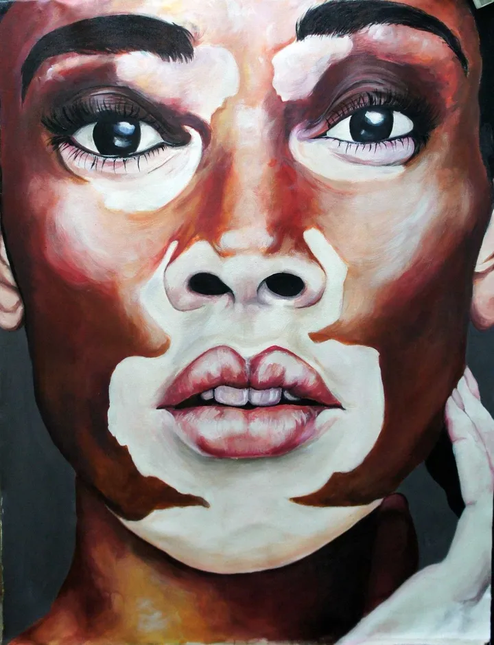 Vitiligo 2, œuvre de valentin melchior