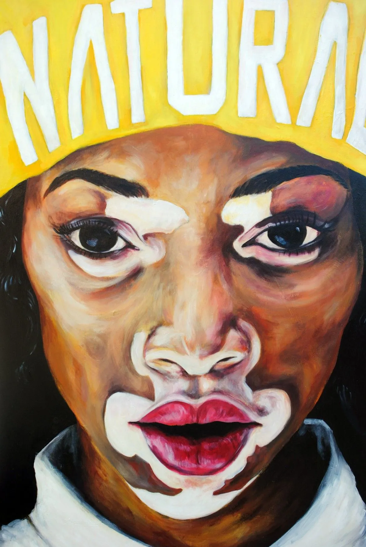 Vitiligo, artwork by valentin melchior